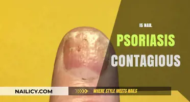 Debunking Myths: The Truth About Nail Psoriasis Contagion