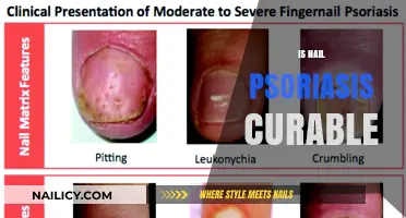 Exploring the Possibilities: Can Nail Psoriasis Be Cured?