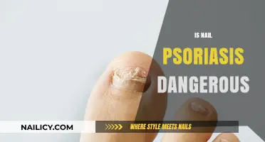 Is Nail Psoriasis Dangerous? Understanding Risks and Management Tips