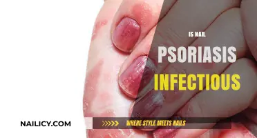 Debunking Myths: Nail Psoriasis - Contagious or Not?