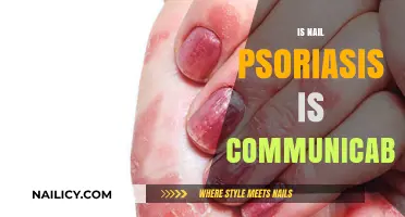 Understanding Nail Psoriasis: Is It Contagious?