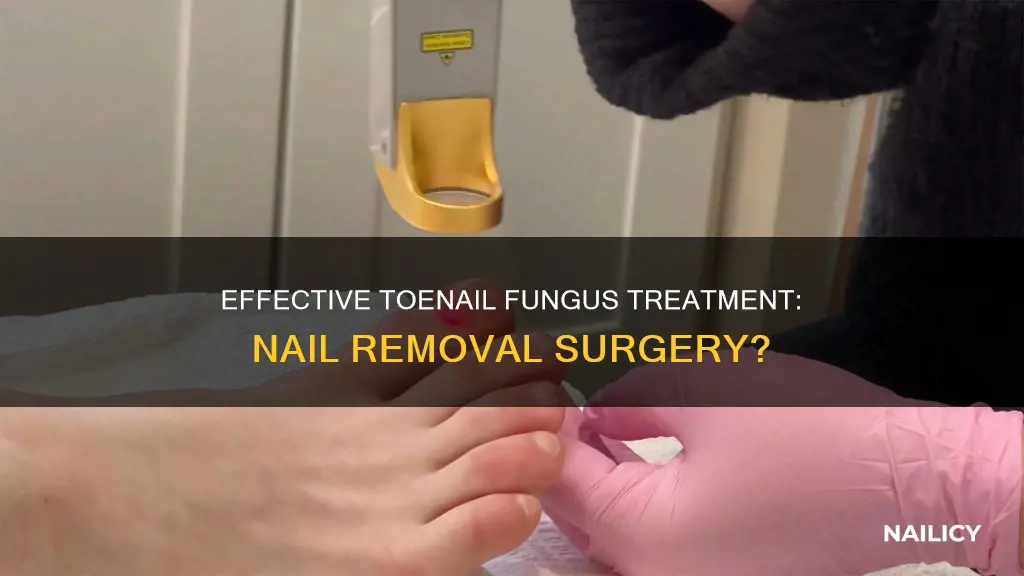 is nail removal an effective treatment for toenail fungus