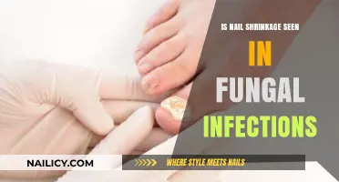 Nail Shrinkage and Fungal Infections: Causes, Symptoms, and Treatment Options