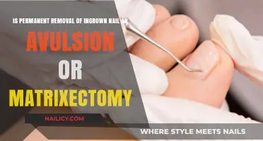 Ingrown Nail: Avulsion or Matrixectomy for Permanent Relief?