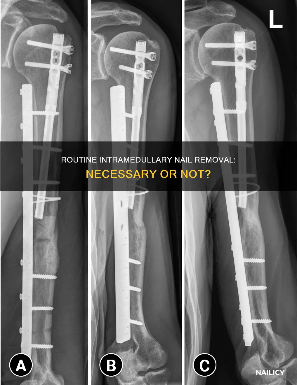 is routine removal of intramedullary nails justified ncbi