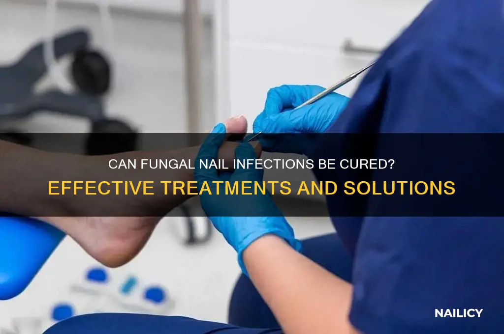 is there a cure for fungi nail