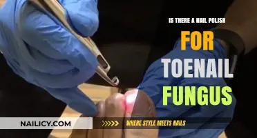 Toenail Fungus Treatment: Can Nail Polish Help Clear Infections?