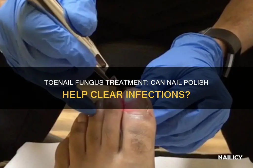 is there a nail polish for toenail fungus