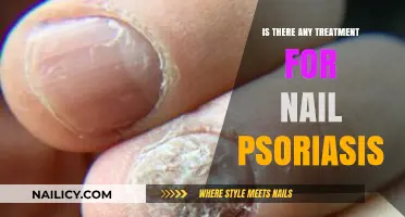 Effective Treatments for Nail Psoriasis: Options and Relief Strategies