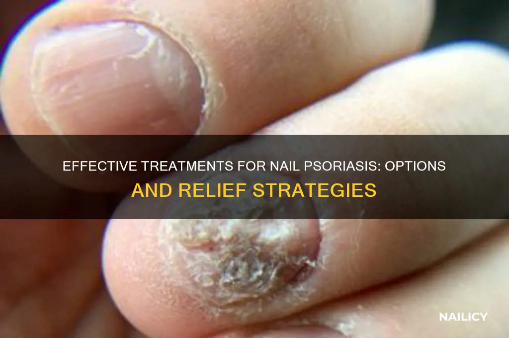 is there any treatment for nail psoriasis