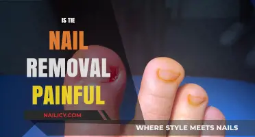 The Pain Factor of Tie Nail Removal