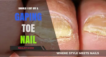 Toe Nail Trauma: Cut or Not?