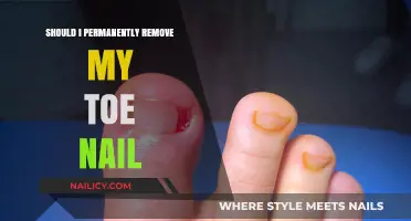 Toe Nail Removal: A Permanent Solution?