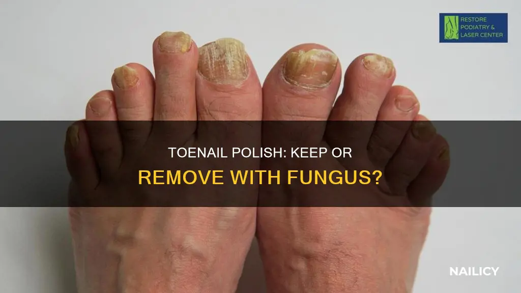 should i remove toenail polish from fungus nail