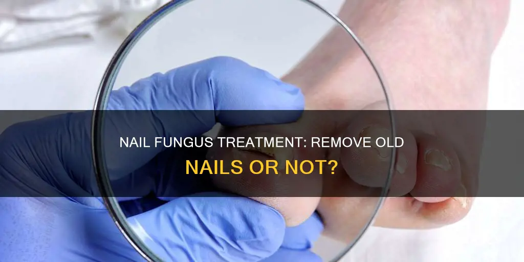 should old nail be removed during nail fungus treatment