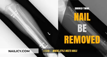 Tibial Nail Removal: When and Why?