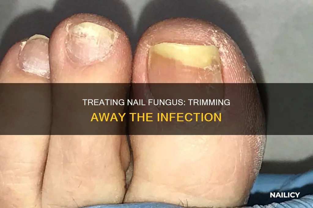 should you cut away bad nail to help nail fungus