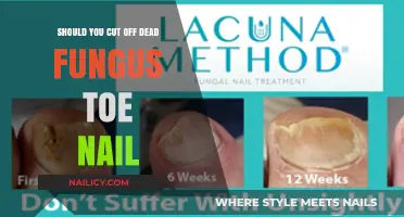 How to Treat a Fungal Toenail Infection