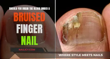 Treating Bruised Fingernails: Drain Blood or Not?