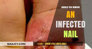 Infected Nails: To Remove or Not to Remove?