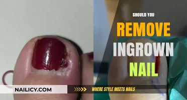 Ingrown Nails: To Remove or Not to Remove?