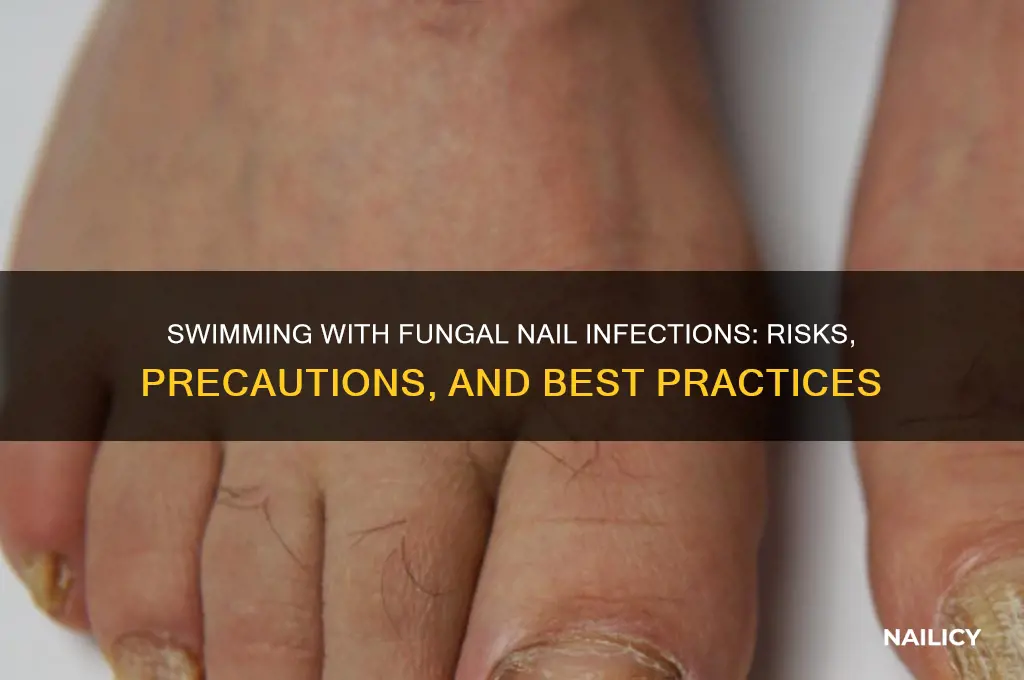 should you swim with a fungal nail infection