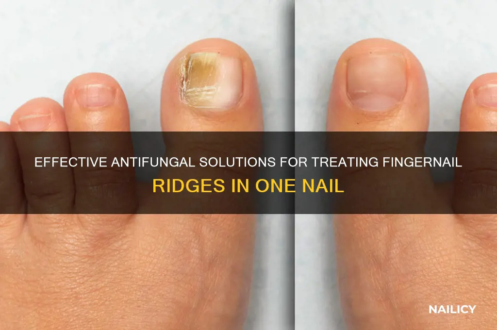 what antifungal for fingernail ridges in one nail