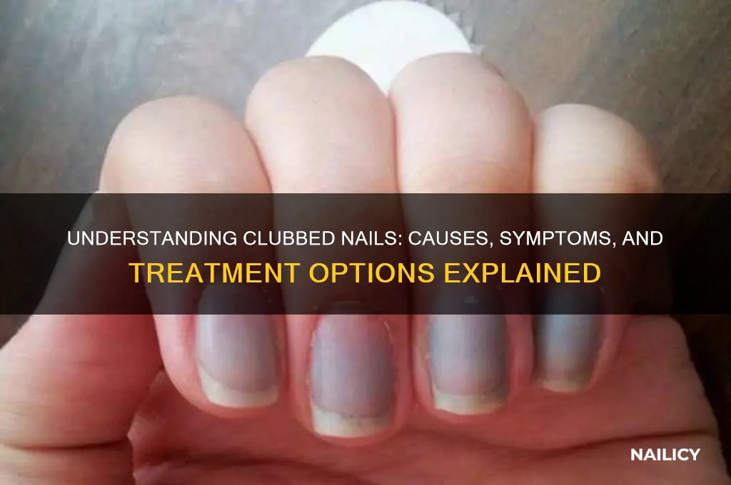what are clubbed nails