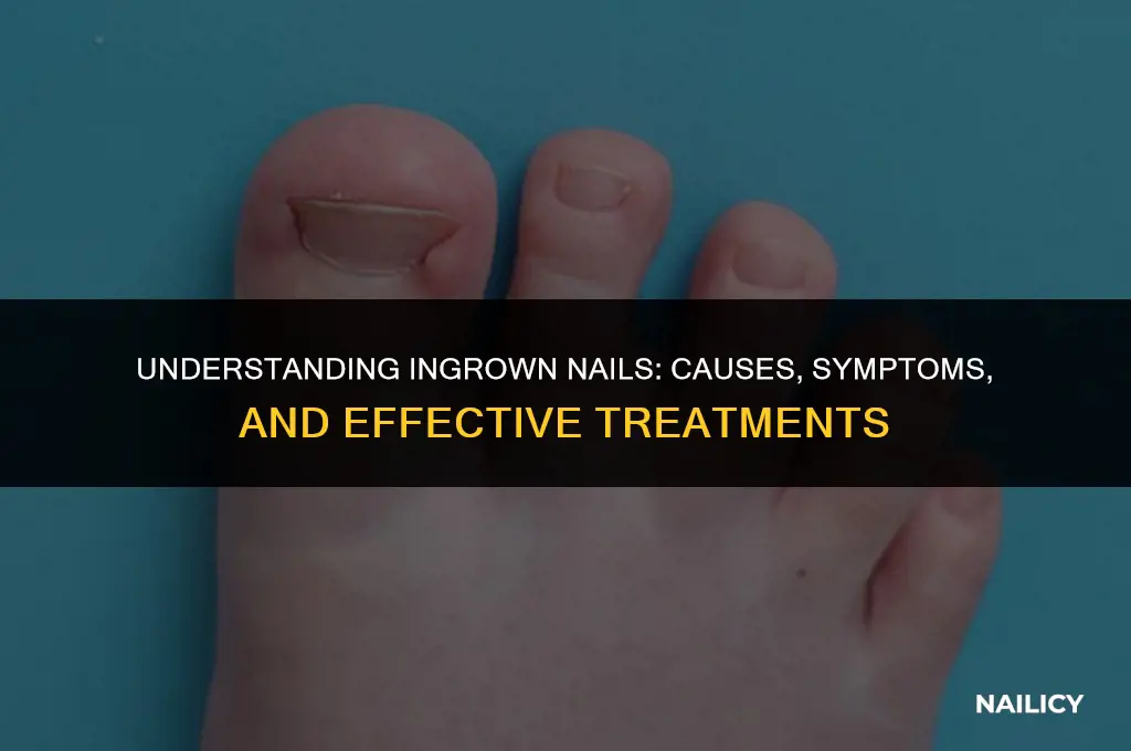 what are ingrown nails
