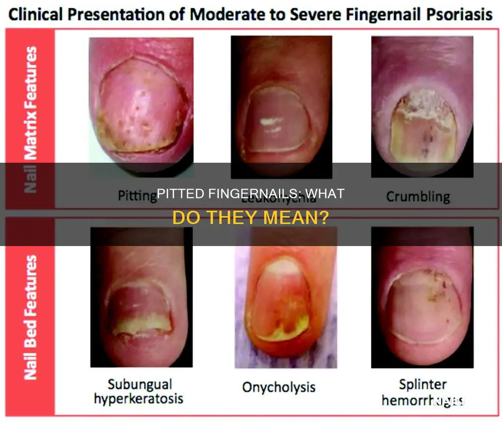 Pitted Fingernails What Do They Mean Nailicy pitted-fingernails-what-do-they-mean-nailicy