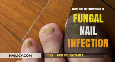 Recognizing Fungal Nail Infection Symptoms: A Comprehensive Guide