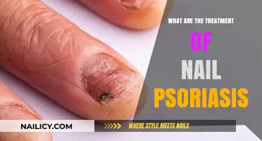 Effective Treatments for Nail Psoriasis: Relief and Management Strategies
