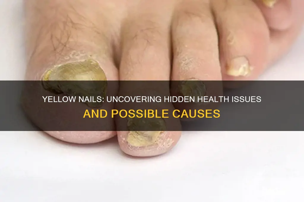 what are yellow nails a sign of