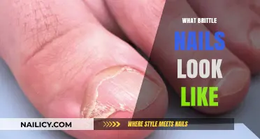 Brittle Nails: Signs, Symptoms, and Treatment Options Explained