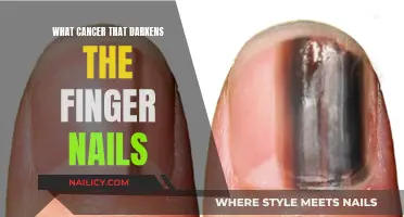 Melanoma: Darkening Fingernails and What It Means