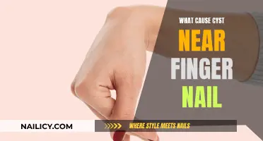 Understanding Cysts Near Fingernails: Causes and Triggers
