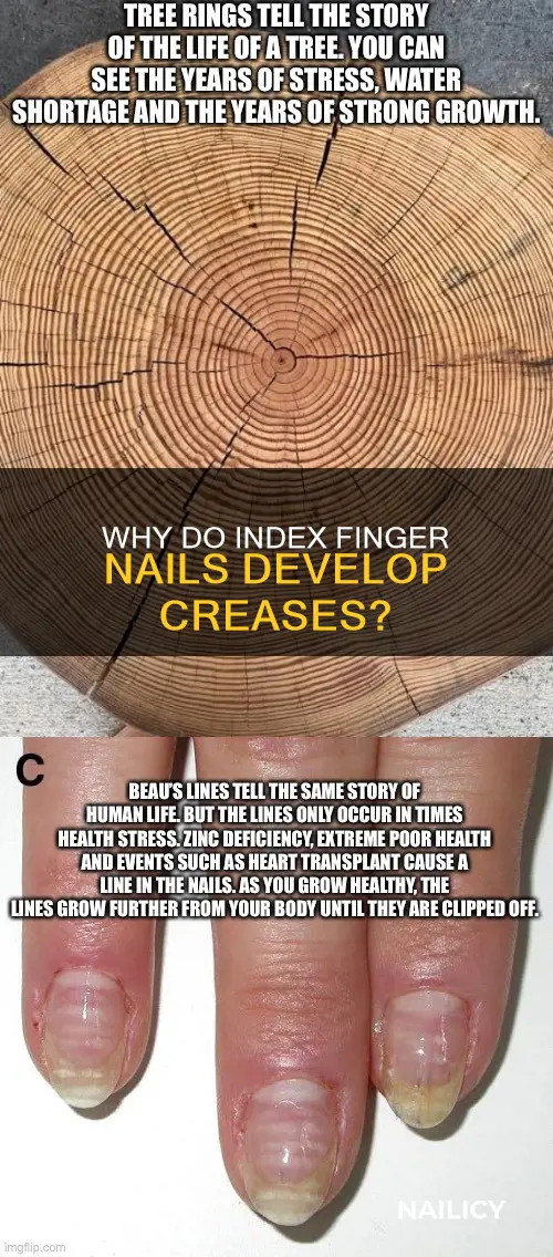 what causes crease in index finger nail