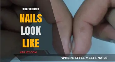 Understanding Clubbed Nails: A Visual Guide to Nail Health