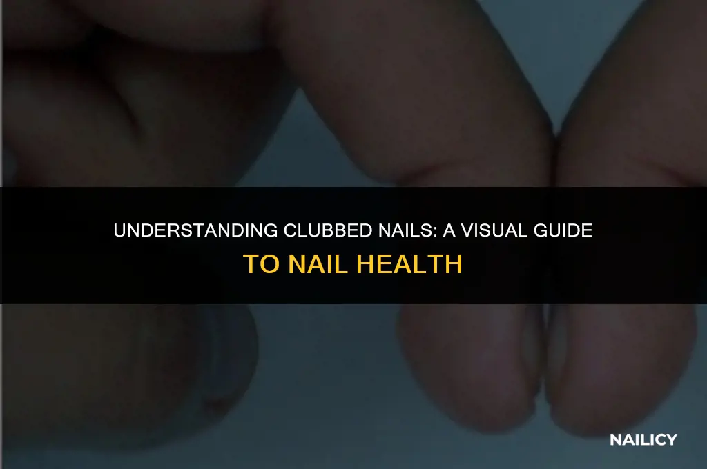 what clubbed nails look like