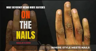 Nail Discoloration: White Blotches and Nutritional Deficiency