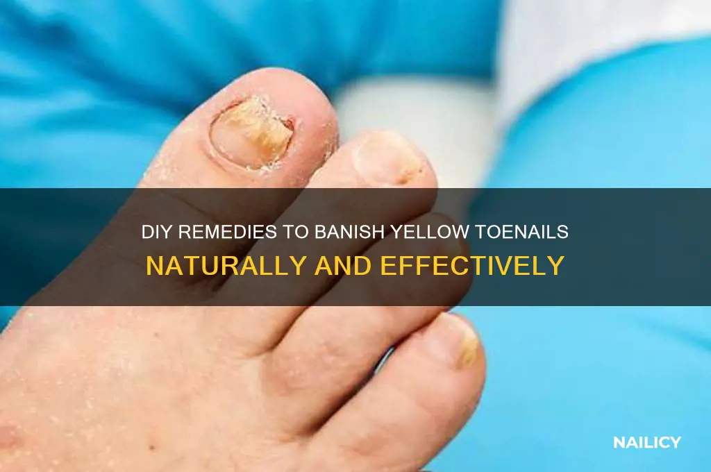 what diy makes yellowness in toe nails go away