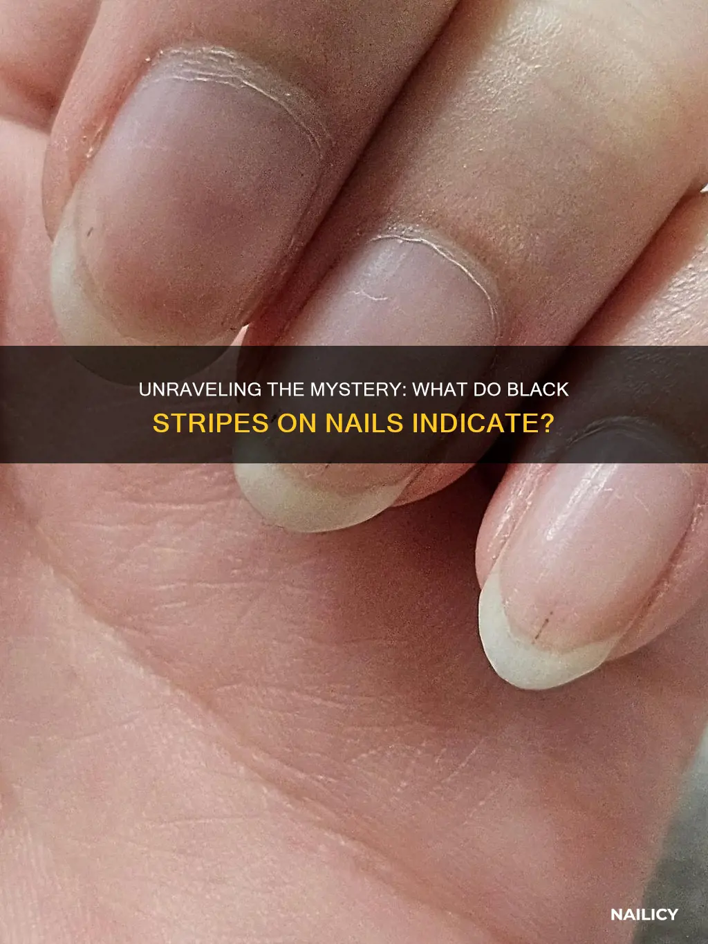 what do black stripes on nails mean