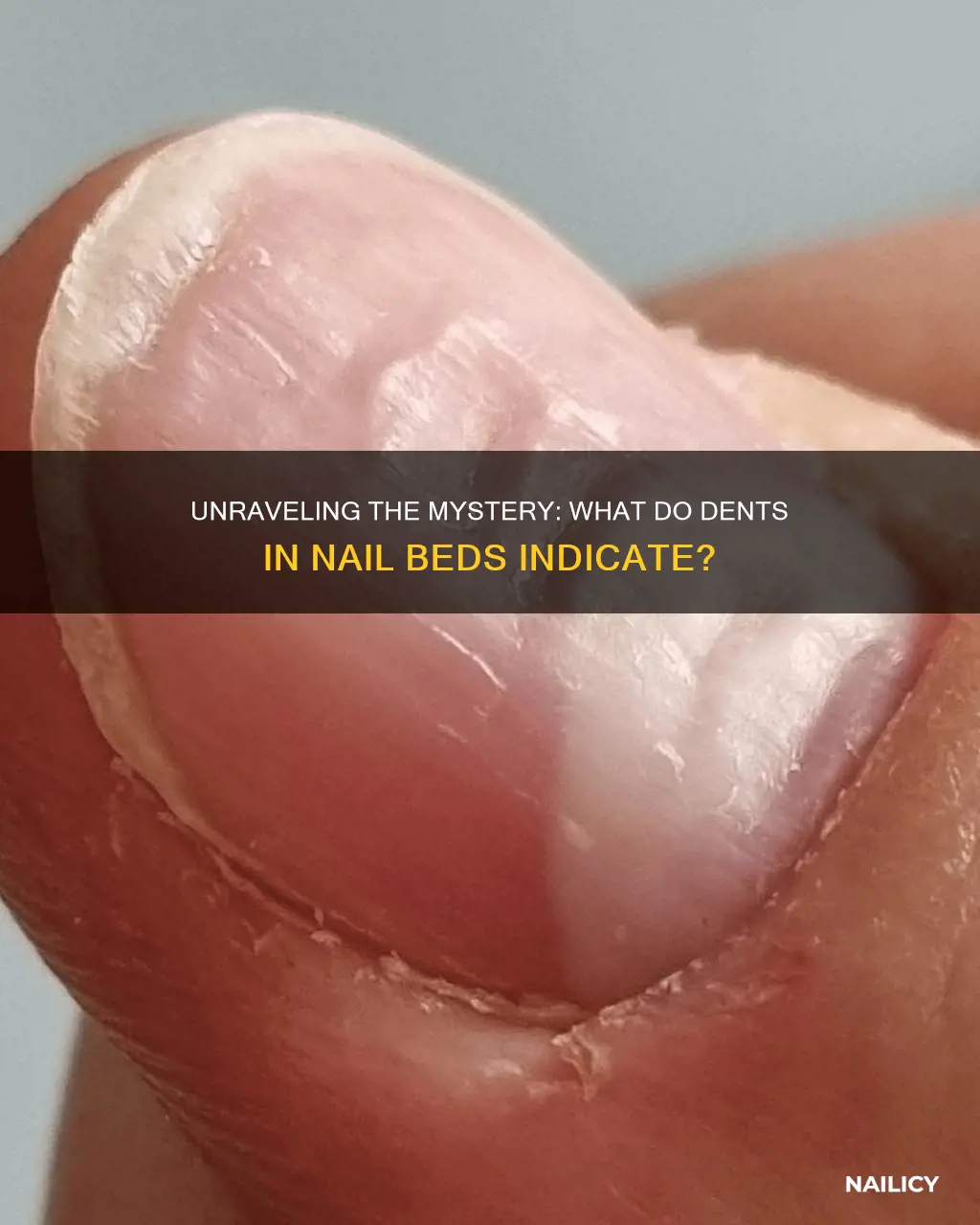 what do dents in nail beds mean