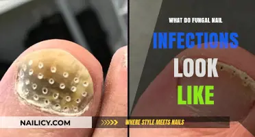 Identifying Fungal Nail Infections: Symptoms, Appearance, and Early Detection Tips