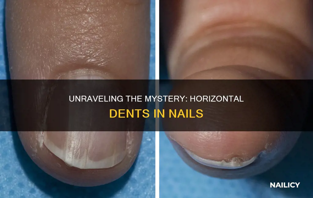 what do horizontal dents in your nails mean