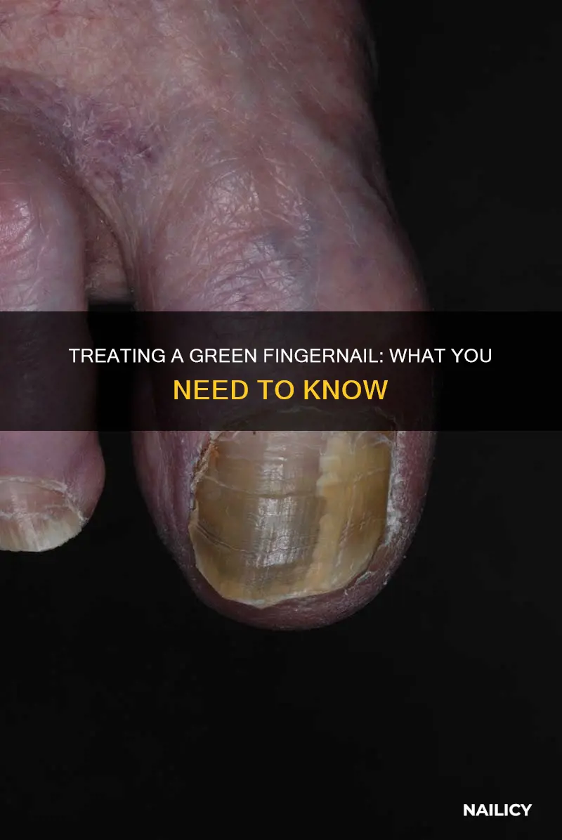 what do i do if my finger nail is green