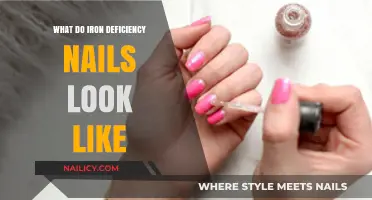 Recognizing Iron Deficiency: Nail Symptoms and Signs to Watch For