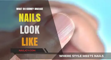 Recognizing Kidney Disease Symptoms: Nail Changes and What They Indicate