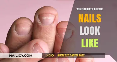 Identifying Liver Disease Through Nail Changes: Symptoms and Appearance