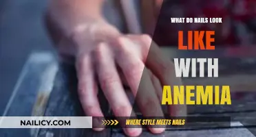 Anemia's Impact: Understanding Nail Changes and Their Appearance